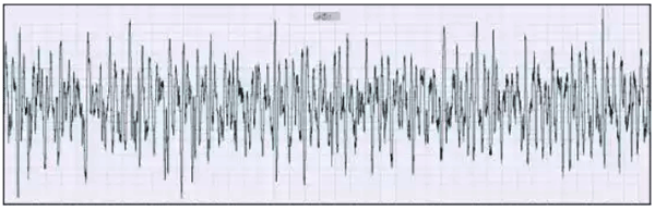 振動干擾下渦街流量計信號曲線 振動干擾下渦街流量計信號曲線